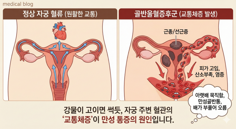 [난임 시리즈 5] 자궁근종에 선근증까지? 아랫배가 늘 묵직한 진짜 이유 관련 이미지